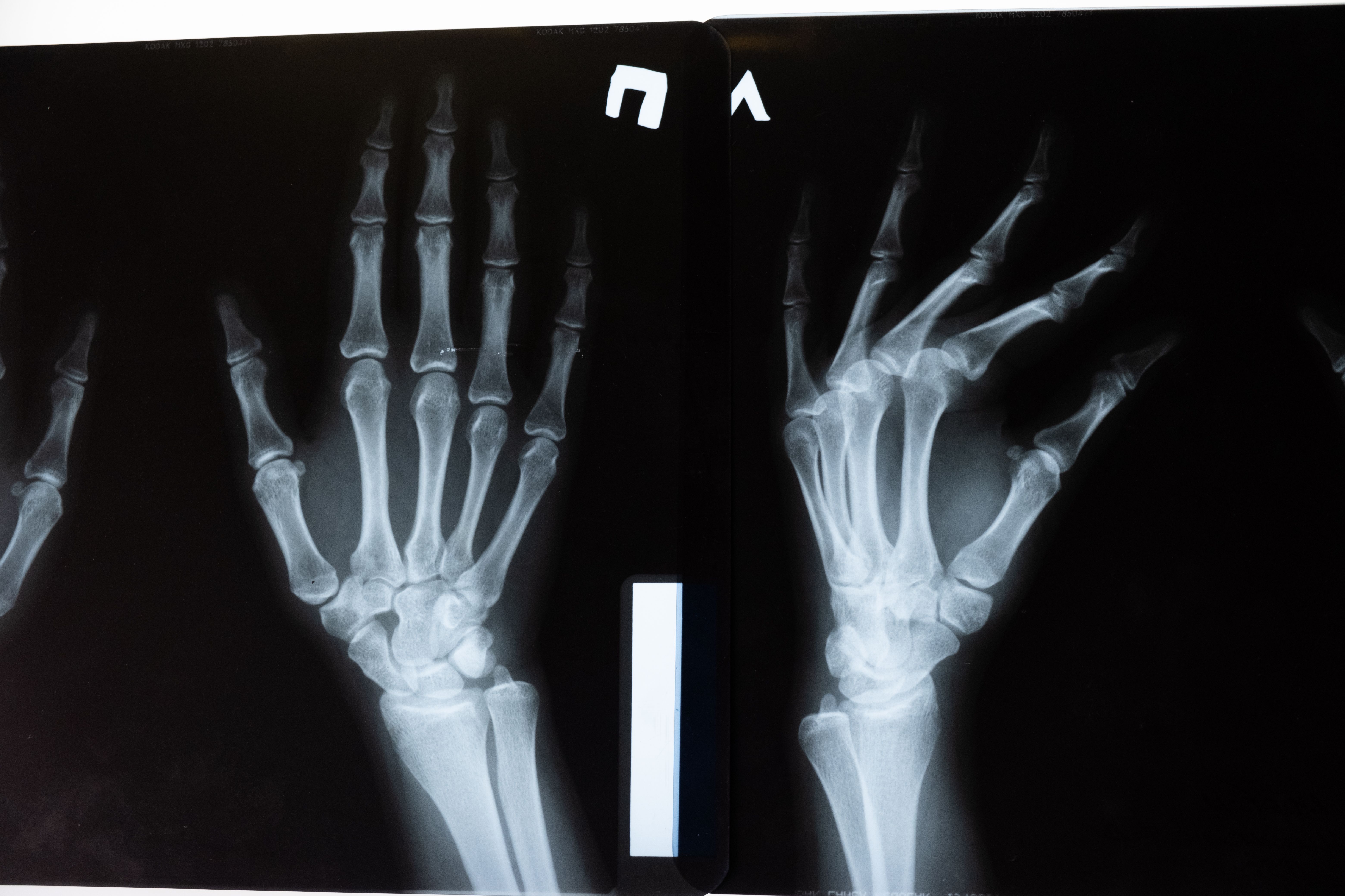 Handheld X-rays Market: Industry Analysis and Forecast
