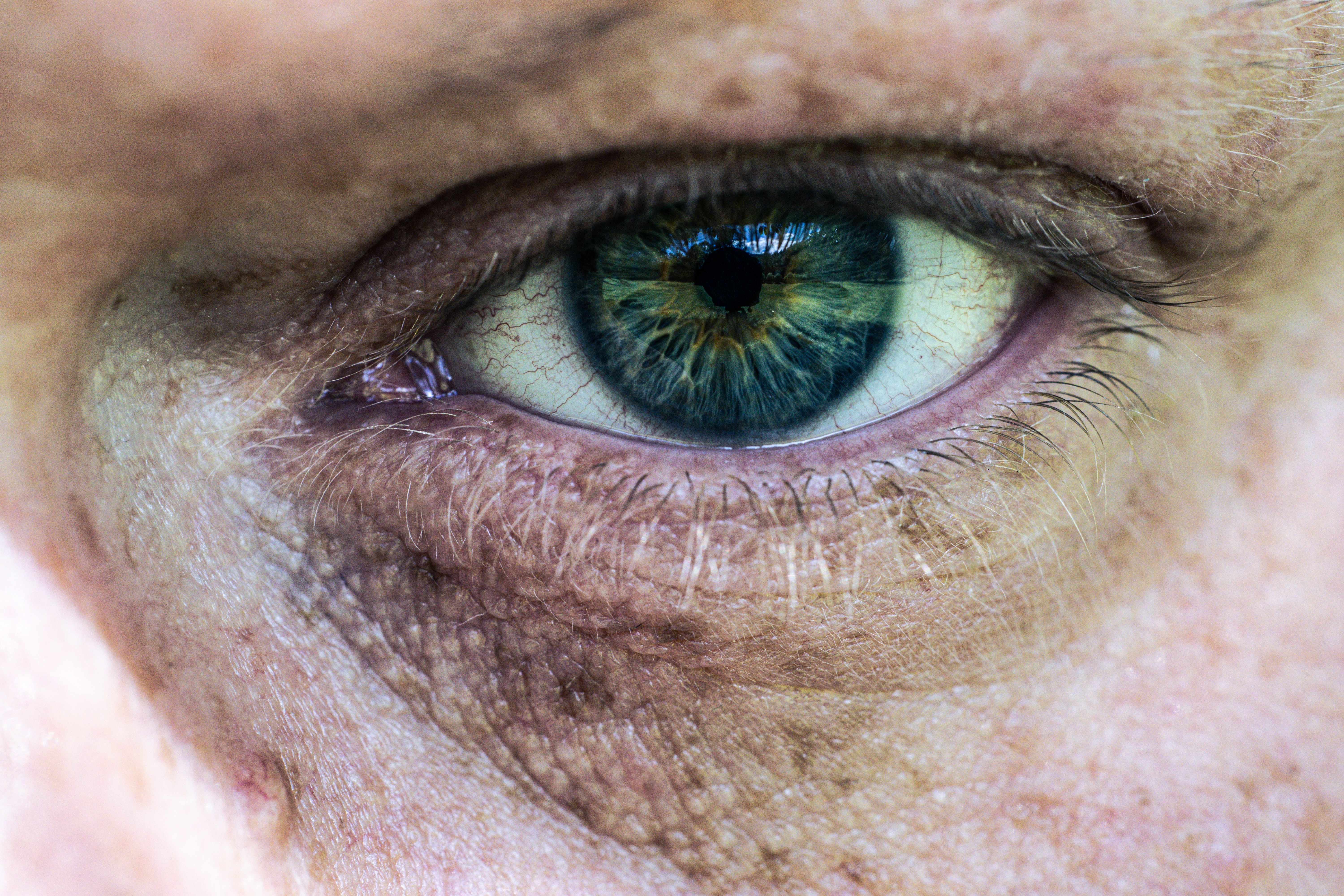 Wilsons Disease Market Outlook: Advancing Diagnosis & Treatment